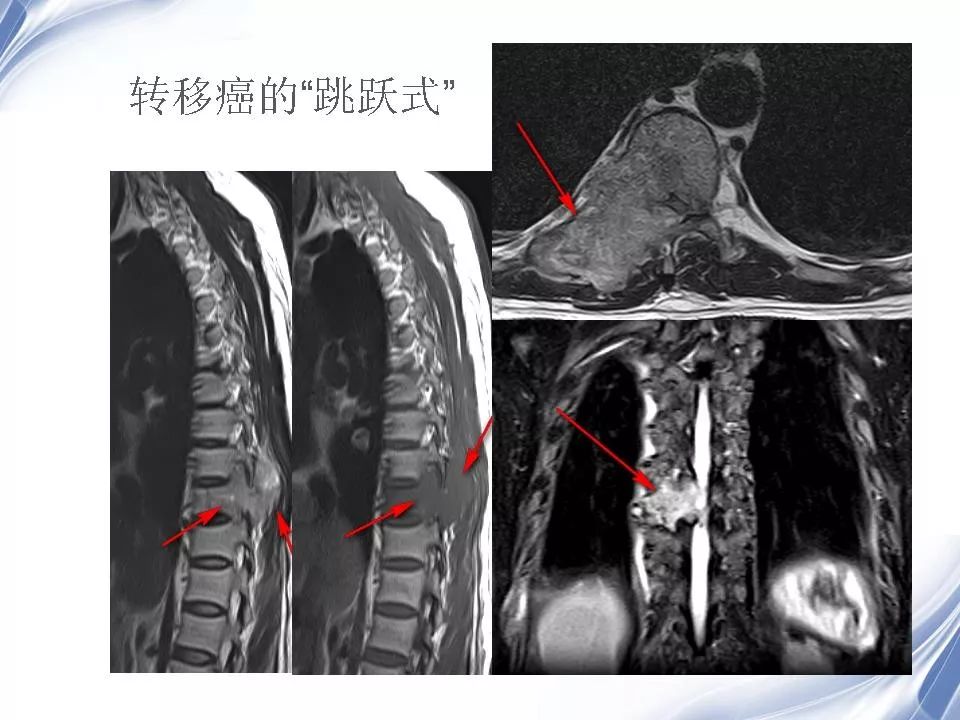 脊柱原发性恶性淋巴瘤的影像诊断 | 影像天地