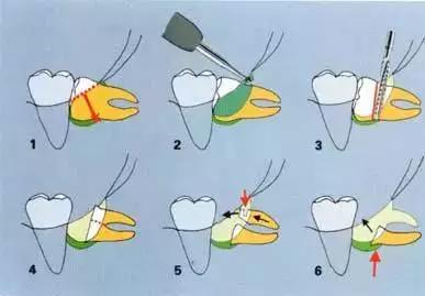 值得牙医收藏的拔牙技巧图解