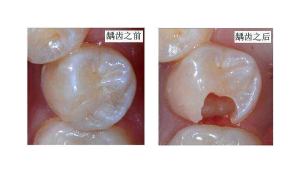 一旦发现龋洞一定要及早治疗