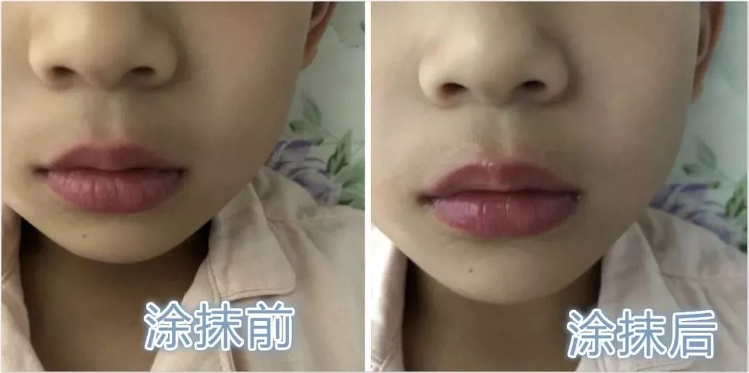 怎么快速止痒消肿最有效 ba2490ca5e5b47259b717635b61894ec.jpeg