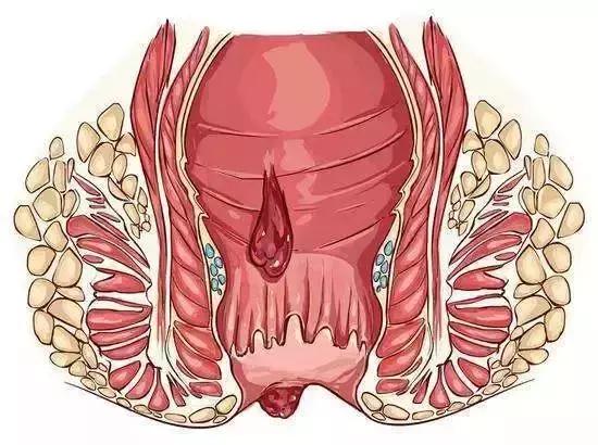 痔疮的症状