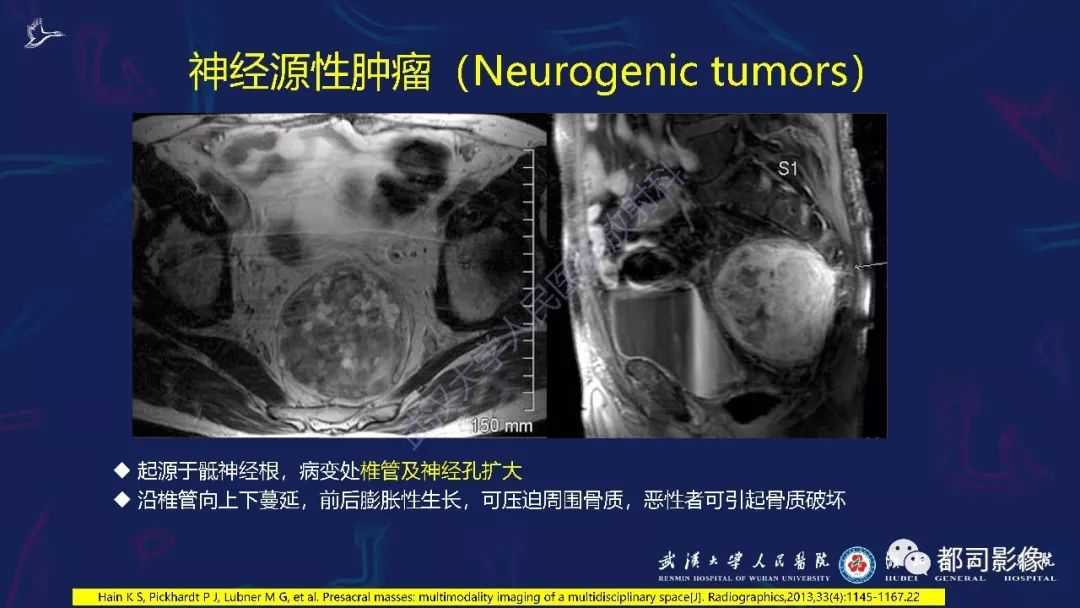 骶尾部肿瘤及肿瘤样病变影像诊断