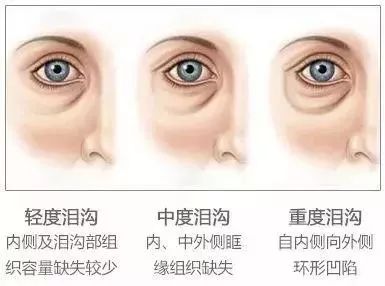 4  与眼袋有关 泪沟是在眼袋的下方 如果眼袋很突出 怎么治疗泪沟