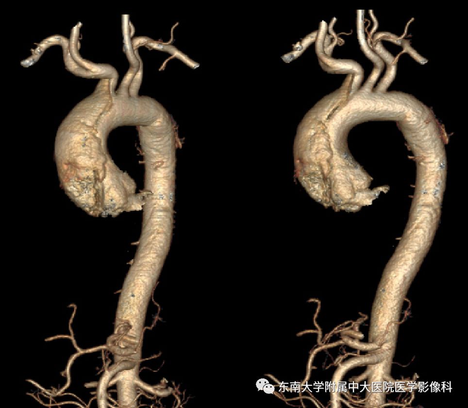 ct 增强 编辑/校对:郑孝飞 病例结果:主动脉夹层,stanford a型 返回搜