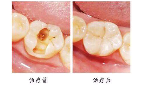 补牙用的激光什么原理_补牙牙套是什么样子的