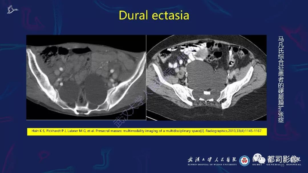 精彩推荐 | 骶尾部肿瘤及肿瘤样病变影像诊断