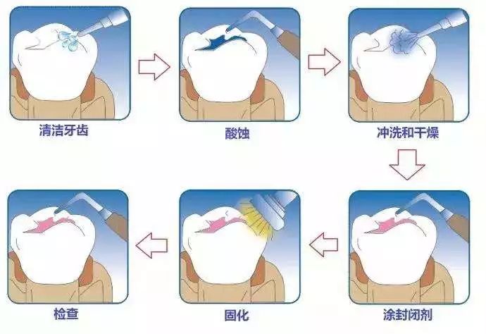 成人口呼吸可以用矫正带吗_口呼吸脸型还能矫正吗(3)