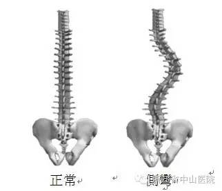 【脊柱养生】脊柱侧弯——花季的烦恼