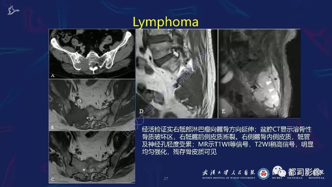 精彩推荐 | 骶尾部肿瘤及肿瘤样病变影像诊断