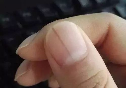 什么病需要切掉手指 0cbdb54c3f82484cb54c746f637400b4.jpeg