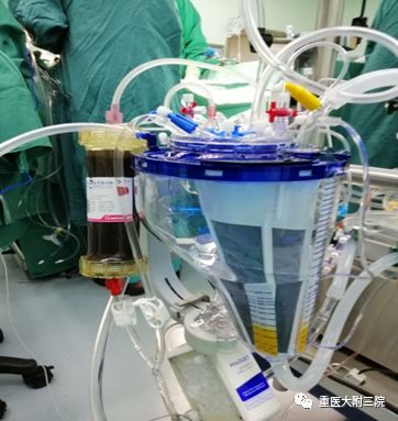 医疗动态我院成功开展吸附型体外循环技术