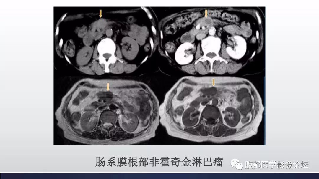 腹膜后及腹股沟区淋巴瘤