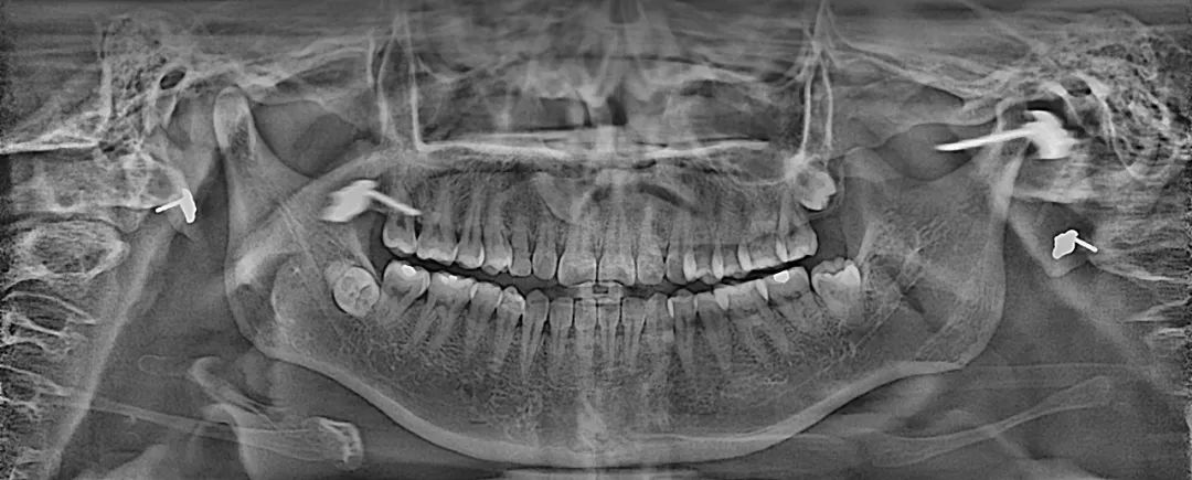 智能3d全景帮助医生便捷直观地发现多种牙齿隐患问题,医患沟通超乎您