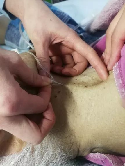 【静疗小技巧】被忽视的静脉通路