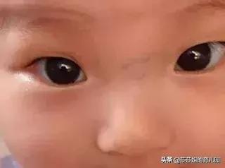                     怎么辨别孩子的前期积食？快看看你家孩子的鼻梁有青筋吗？