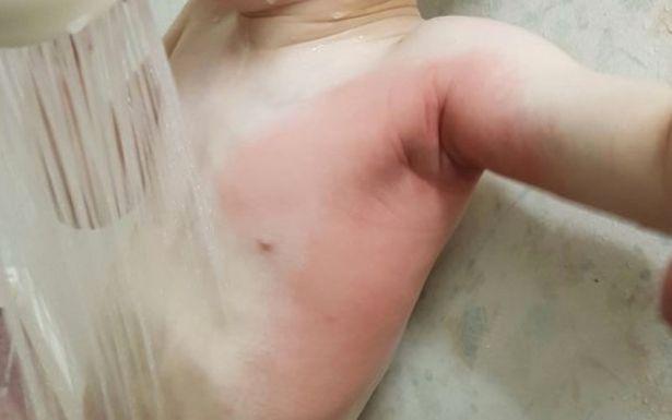                    两岁孩子身体被大面积烧伤，凶手是没洗干净的衣服