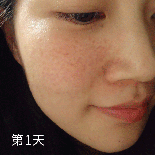 皮肤明显白皙了,色斑也淡化了!
