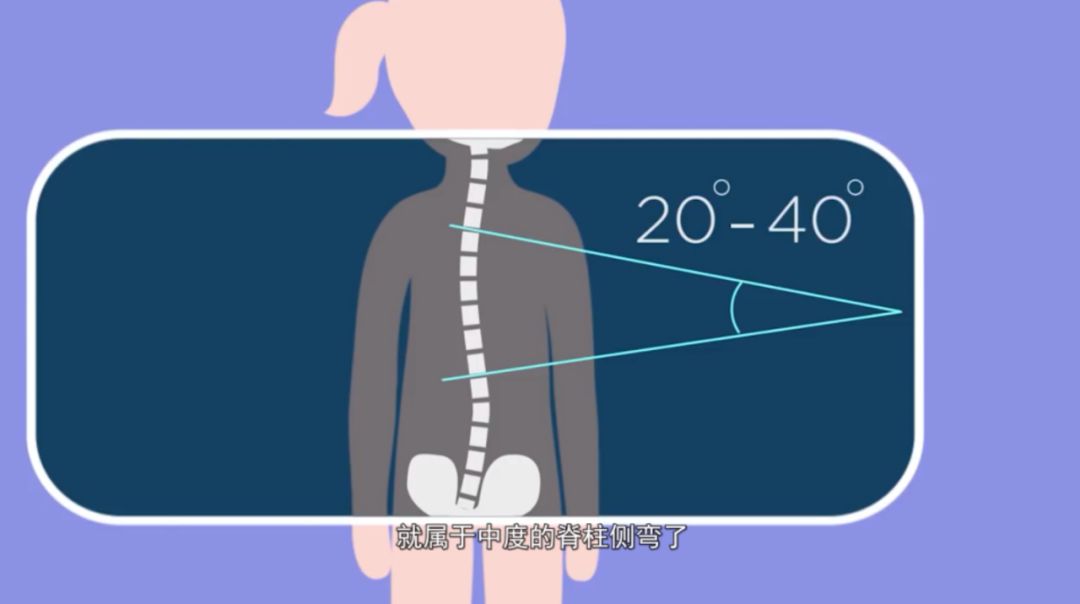 20~40°的侧弯,就属于中度的脊柱侧弯,需要使用支具进行治疗.