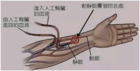 动静脉内瘘术后居家护理