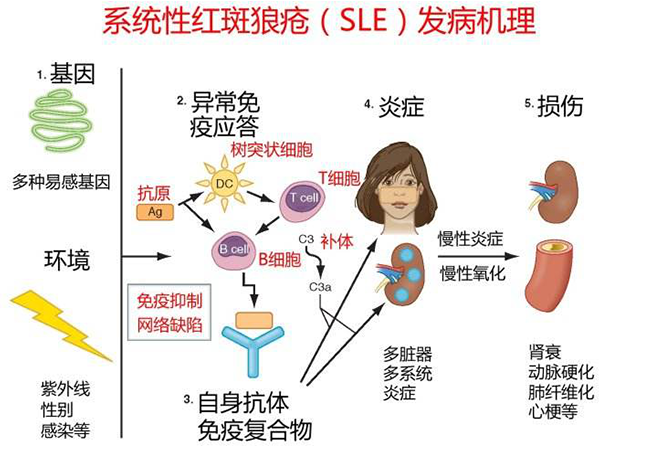 系统性红斑狼疮是什么发病有3个前兆你中了吗