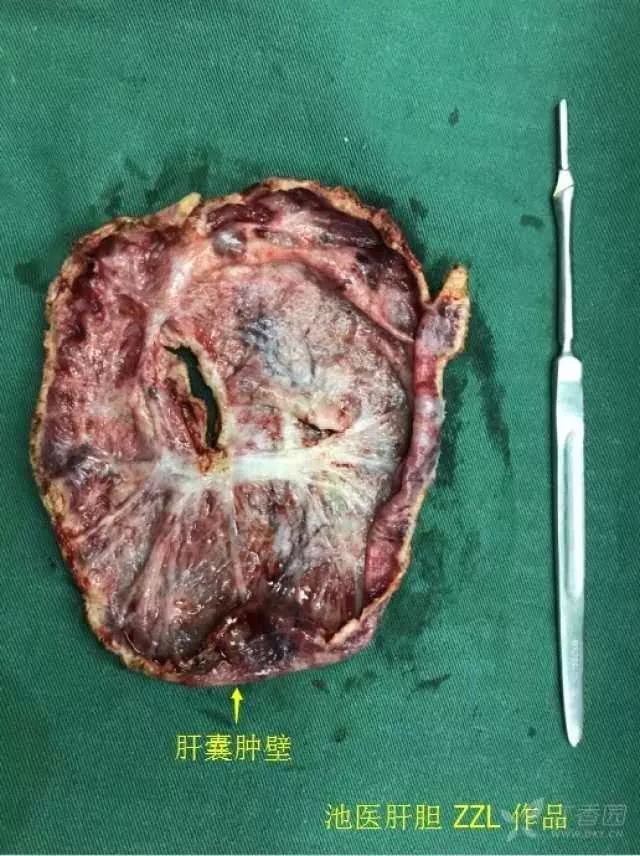 腹腔镜巨大肝囊肿开窗 带蒂网膜填塞引流术图解