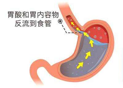 省医药院附院胃肠医生详解反流性食管炎