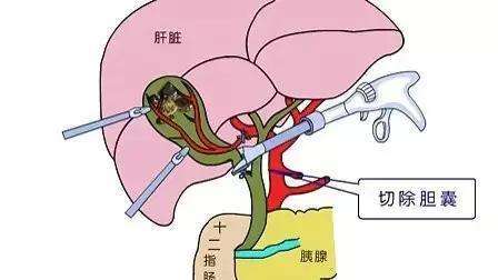 "医生,我做完胆囊切除手术会有啥影响?