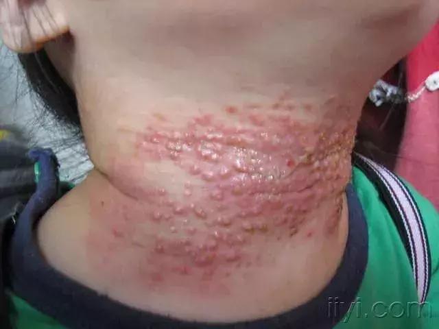                     夏天到了，一大批皮肤病即将袭击孩子……