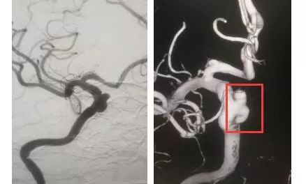 入院后磁共振血管成像提示右侧颈内动脉c5段动脉瘤 全脑血管造影提示