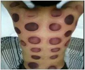 拔罐为什么会紫黑 65d8f9d113e94219925f6888b225acb8.jpeg