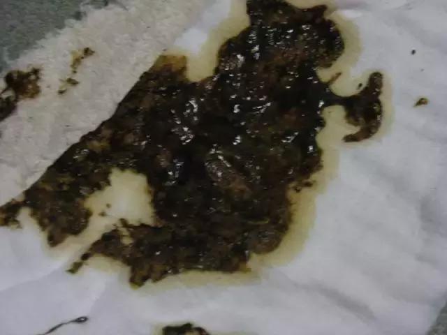                     奶瓣、绿便、腹泻、便秘...宝宝的各种便便真图全解！建议收藏~