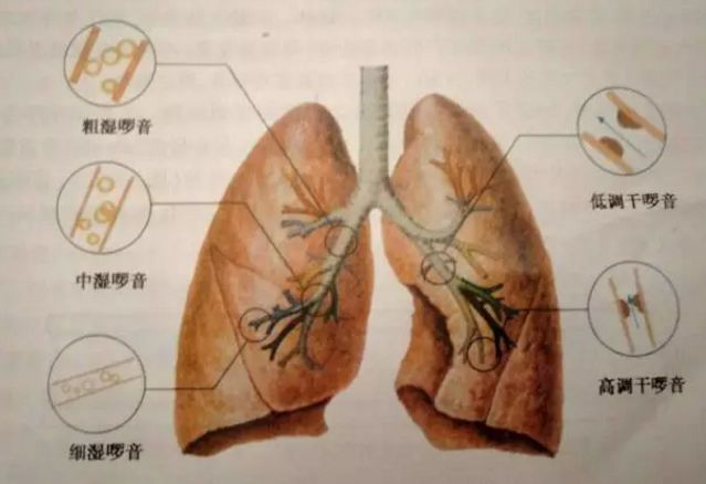 每日一听实践技能第三站心肺听诊中湿啰音