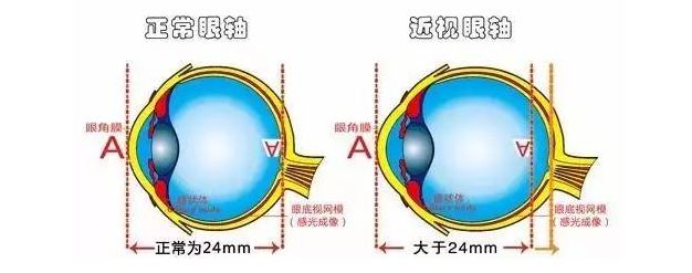 近视原因可以有轴性近视,曲率性近视,指数性近视等,其中比较常见的是