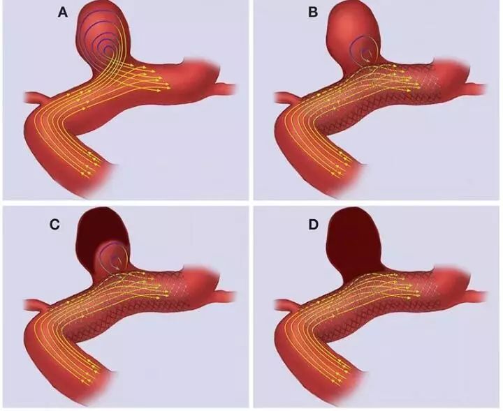 血流动力学障碍被认为是颅内动脉瘤发生,进展和破裂的一个主要因素