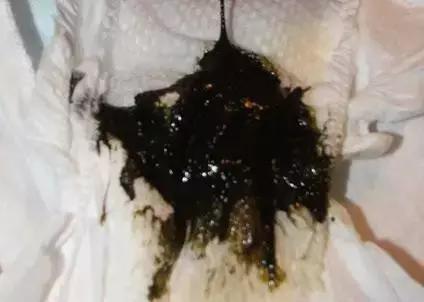                     奶瓣、绿便、腹泻、便秘...宝宝的各种便便真图全解！建议收藏~