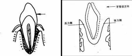 做牙套的原理_牙齿矫正的原理,原来牙套是这样移动的