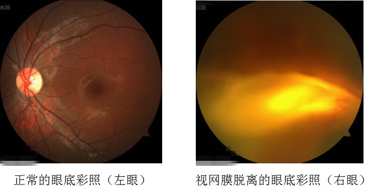 视力检查有多重要?七岁女童视网膜脱离,原因竟是