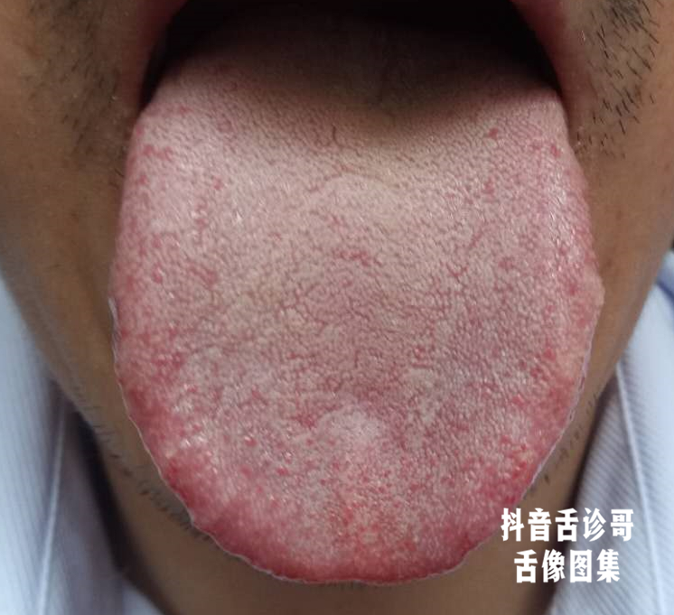 舌诊哥:舌诊知健康,教你学会看舌象系列五十三