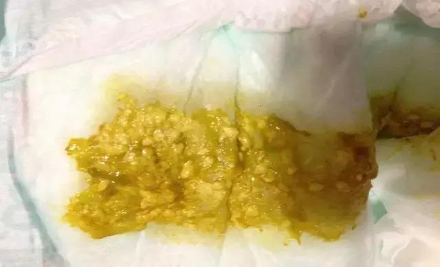                     奶瓣、绿便、腹泻、便秘...宝宝的各种便便真图全解！建议收藏~