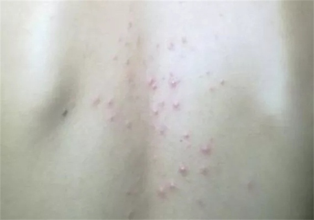 什么叫毛囊性丘疹 e21b224e1a4e4f64ab4c562d7d5294d8.png