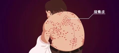 梅毒疹(图片来自网络)