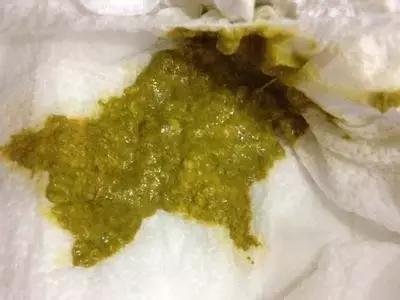                     奶瓣、绿便、腹泻、便秘...宝宝的各种便便真图全解！建议收藏~