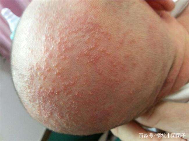                     新如何判断新生儿湿疹？宝宝患湿疹后应该如何护理？