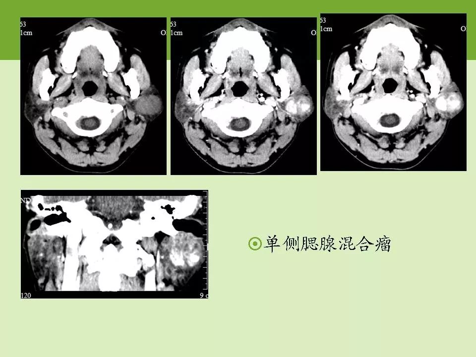 腮腺区常见病变的ct鉴别诊断影像天地