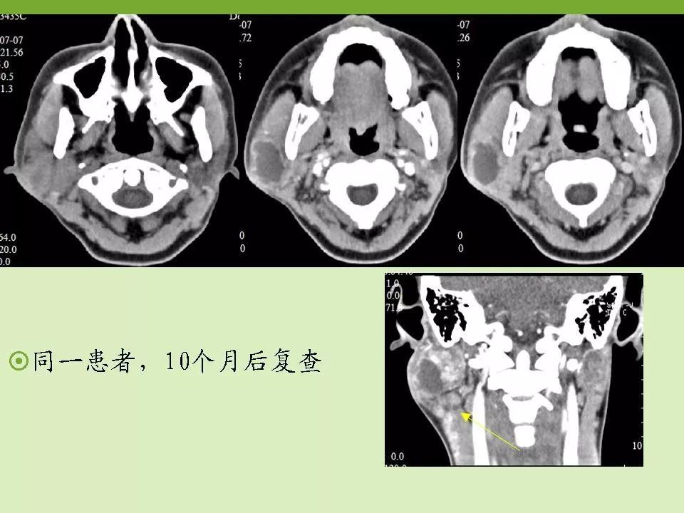 腮腺区常见病变的ct鉴别诊断 | 影像天地