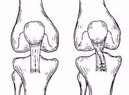 膝盖积水是如何造成的 6a4fdb485dfc4e128b818f81c8c6bff7.jpeg