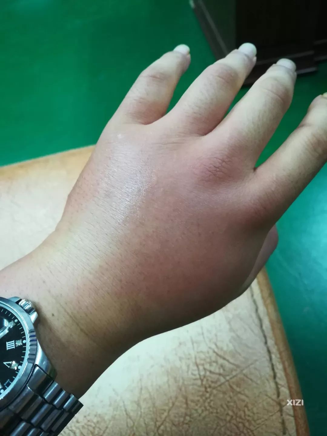 【广东】惠州一网友被小蚂蚁咬了,结果肿成"猪蹄"