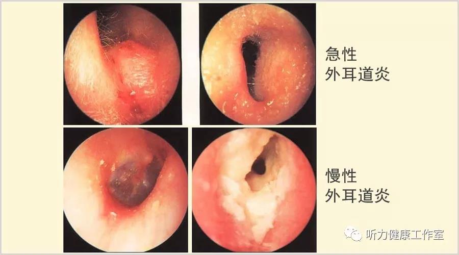 外耳道炎 外耳道炎为 细菌,真菌感染或变态反应