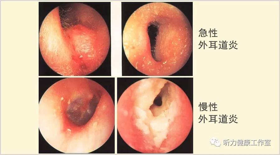 急性者以浸润性炎症为主,慢性者以脱屑为主.