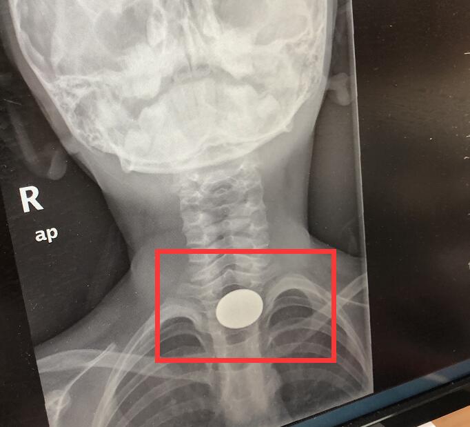                     苏州一男童误吞一元硬币险送命 家长千万不能让孩子做这件事……